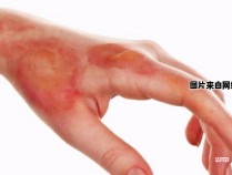 烧伤后的皮肤需要怎样进行处理？