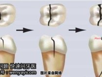 牙齿裂缝的自然修复方法