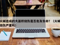 火碱造成的大面积烧伤是否危及生命？（火碱烧伤严重吗）