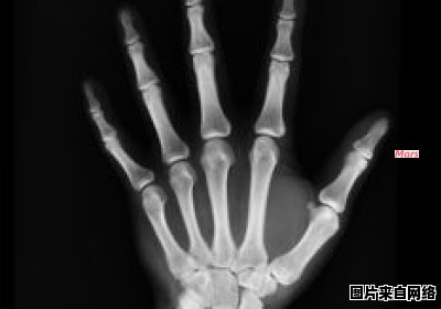 手骨折康复需要多长时间 手骨折后期康复目标和措施