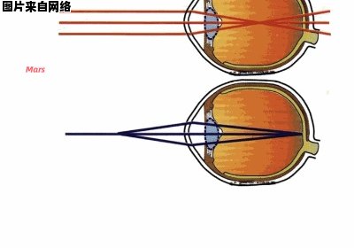 转动眼球是否能治疗近视眼？