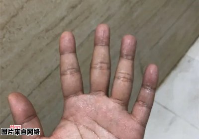 男性手心出汗的原因是什么